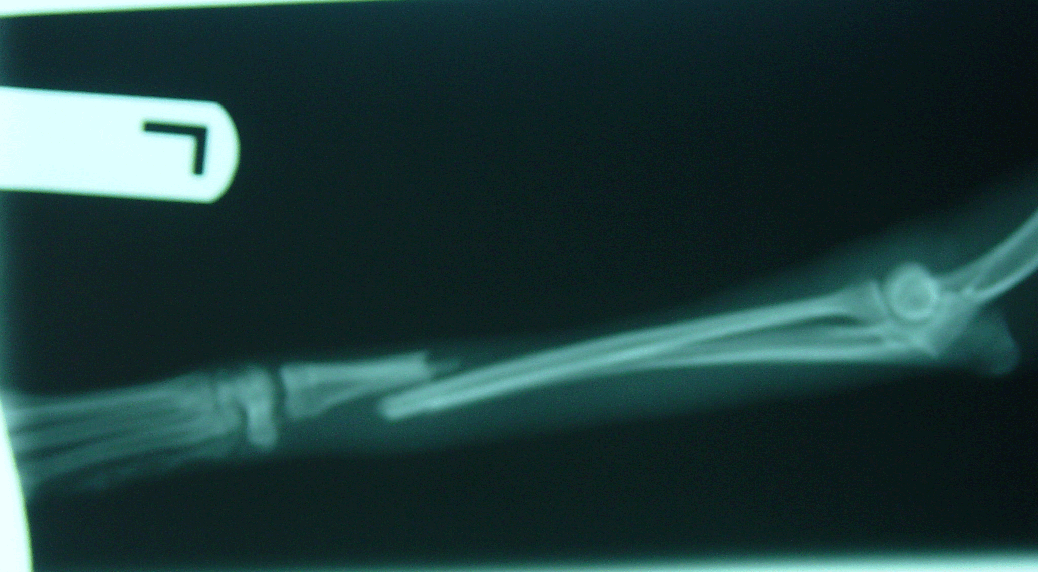 Xray of a fracture